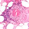 4A3 Vasculitis, Churg-Strauss (Case 4) H&E 40X 7
