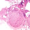 4A4 Vasculitis, Churg-Strauss (Case 4) H&E 10X 1