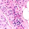 4A8 Vasculitis, Churg-Strauss (Case 4) H&E 60X 2