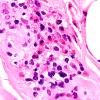 4A9 Vasculitis, Churg-Strauss (Case 4) H&E 100X 4A