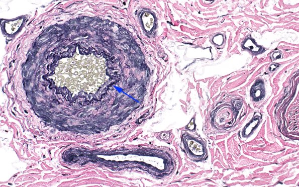 10A2 Elastin (Case 10) 40X copy