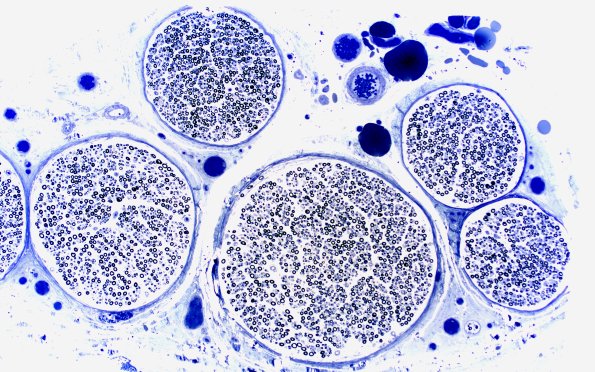 11A1 (Case 11) Plastic 10X 1