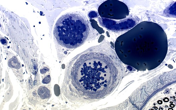 11A2 (Case 11) Plastic 210X 1