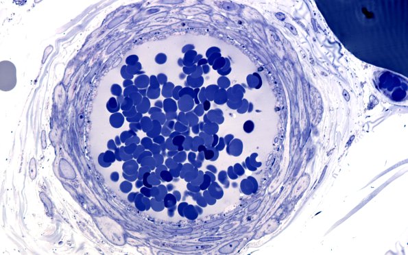 11A3 (Case 11) Plastic 100X 1