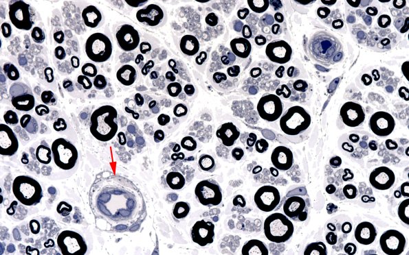 11A4 (Case 11) Plastic 100X 2 copy