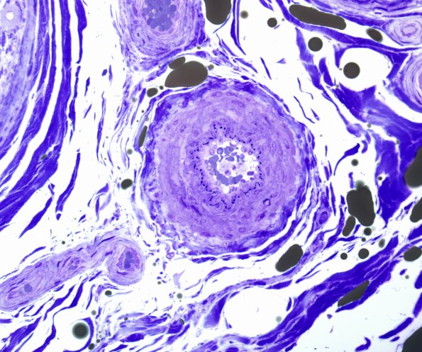 12A1 Artery, epineurial (Case 12) Plastic 2