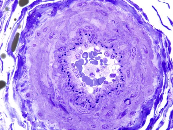 12A2 Artery, epineurial (Case 12) Plastic 1