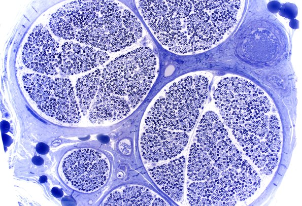 13A1 (Case 13) 10X 1