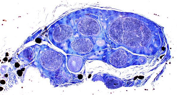 14A1 (Case 14) Plastic 4X