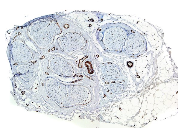 15A Nerve, vasculature (Case 15) SMA 2