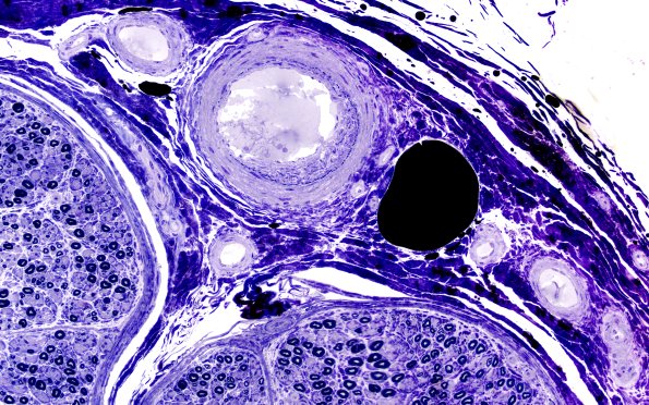 16A2 (Case 16) Plastic 40X