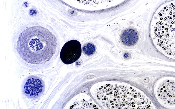 2A2 (Case 2) Plastic section 20X 1