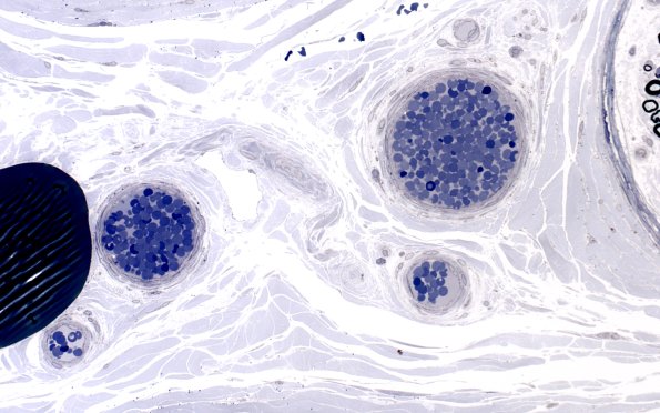 2A4 (Case 2) Plastic section 40X 2