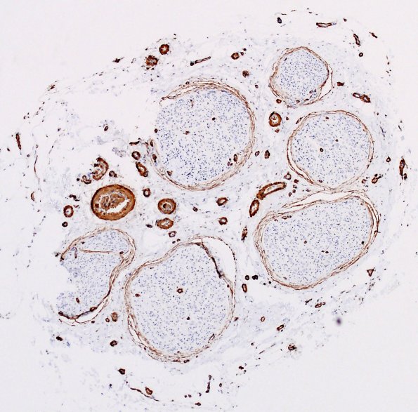 4A2 Nerve, vasculature (Case 4) SMA 3