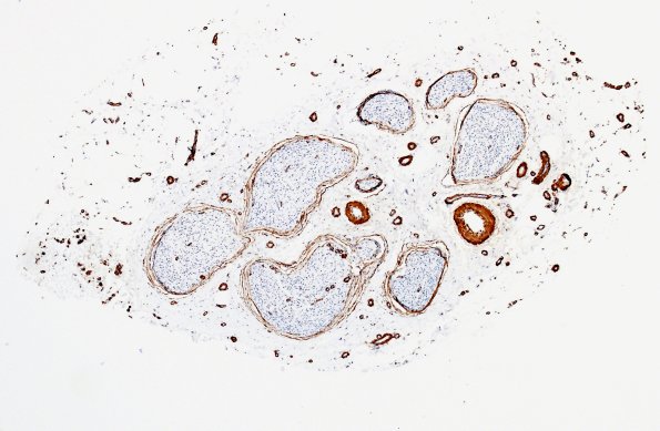 4A3 Nerve, vasculature (Case 4) SMA 2