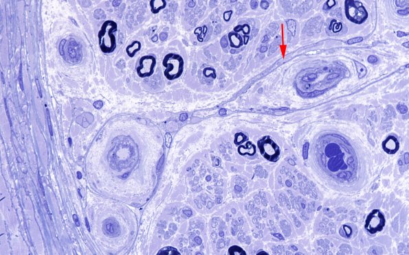 5A1 Endoneurial vessels (Case 5) - Copy copy