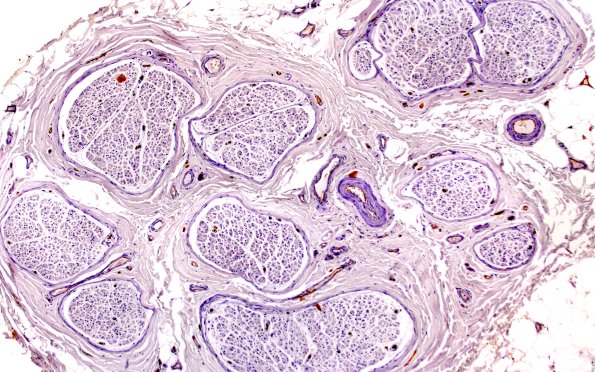 6A1 Ulex (Case 6) 10X 2