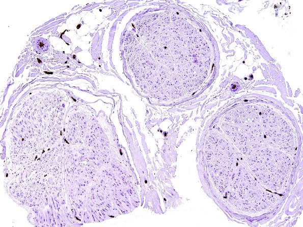 6A2  (Case 6)  Ulex 1