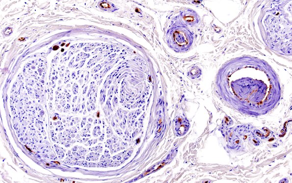 6A4 Ulex (Case 6) 20X 1