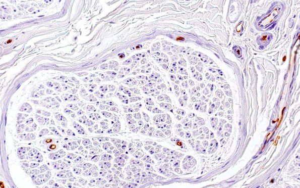 6A5 Ulex (Case 6) 40X 2