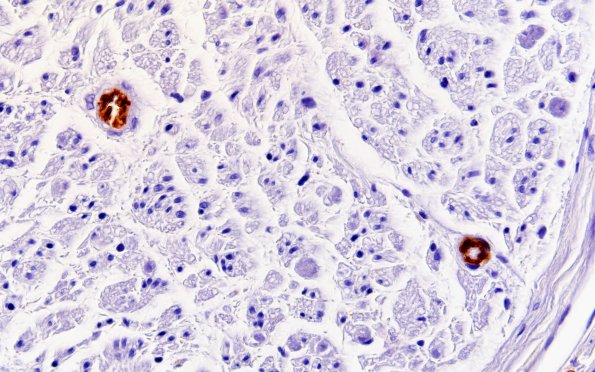 6A6 Ulex(Case 6) 60X 1