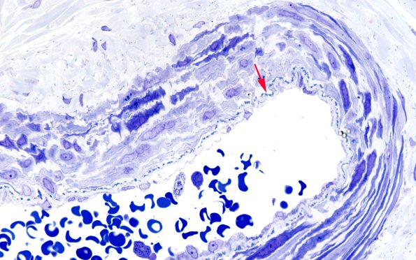 7A5 (Case 7) 100X 1 copy