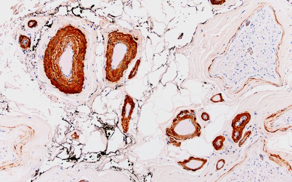 8A2 (Case 8) SMA 20X 1