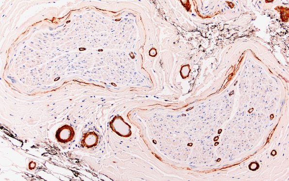 8A3 (Case 8) SMA 20X 2