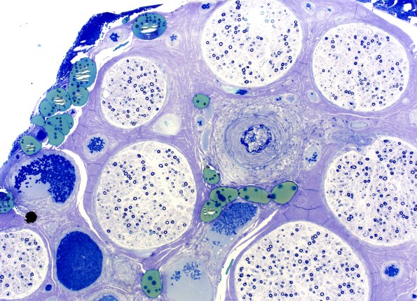 10A1 PAN (Case 10) Plastic 4X 1