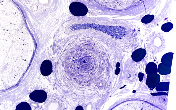 10A3 PAN (Case 10) 20X 1