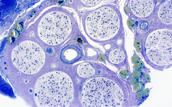 10A5 PAN (Case 10) Plastic 4X 2