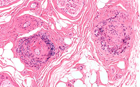 11A2 PAN (Case 11) H&E 2X 1