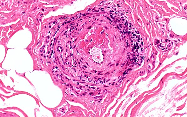 11A3 PAN (Case 11) H&E 40X 1