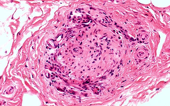 11A4 PAN (Case 11) H&E 40X 2