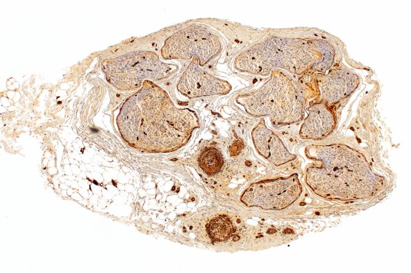 11B1 PAN (Case 11) SMA 4X