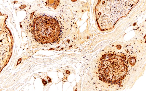 11B2 PAN (Case 11) SMA 20X