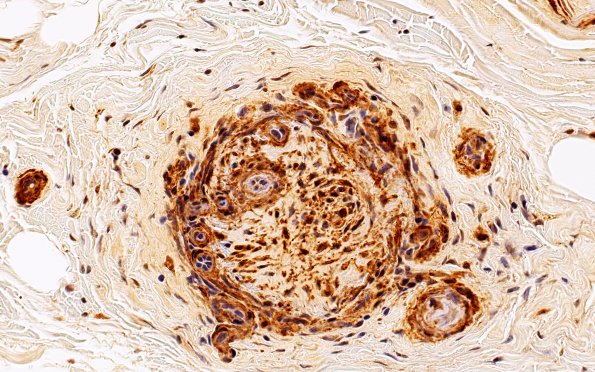 11B3 PAN (Case 11) SMA 40X