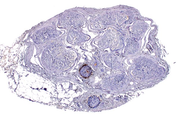 11C1 PAN (Case 11) CD45 4X