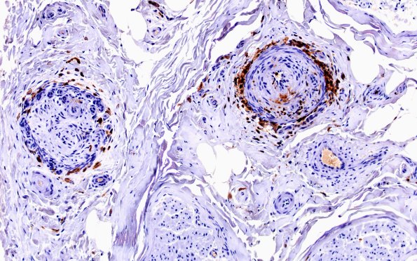 11C2 PAN (Case 11) CD45 20X