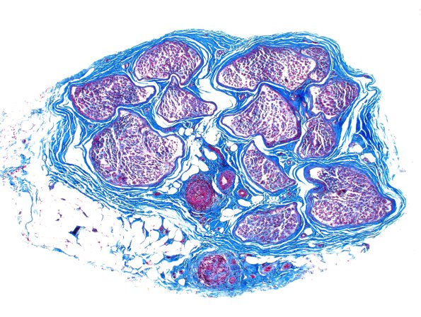 11D1 PAN (Case 11) TRI 4X