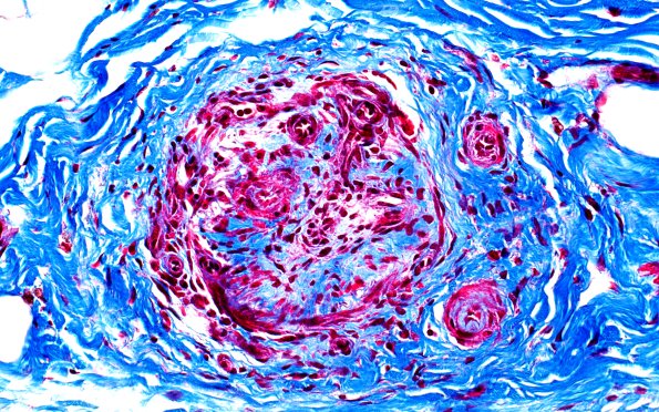 11D2 PAN (Case 11) TRI 40X