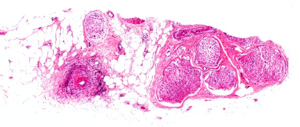 12A1 PAN (Case 12) H&E 4X 1