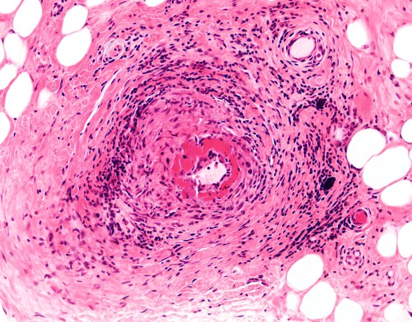 12A2 PAN (Caase 12) H&E 20X 1