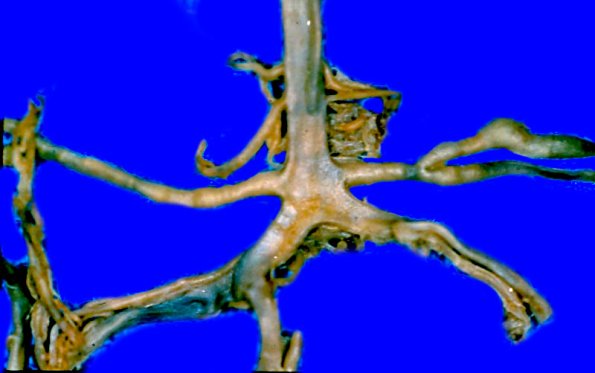 13A1 PAN (Case 13) Circle of Willis