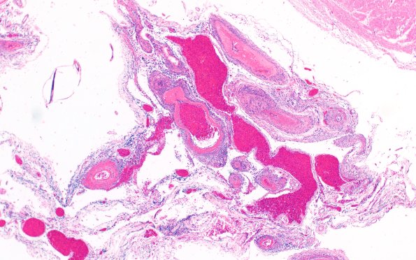 13B2 PAN (Case 13) H&E 4X 2