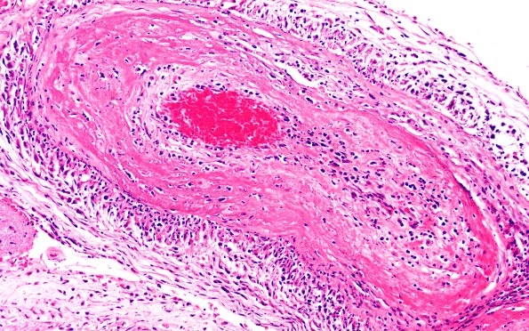 13B4 PAN (Case 13) H&E 20X 3