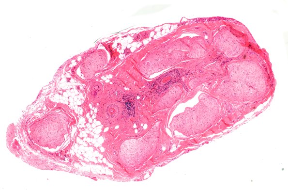 14A1 PAN (Case 14) H&E 4X