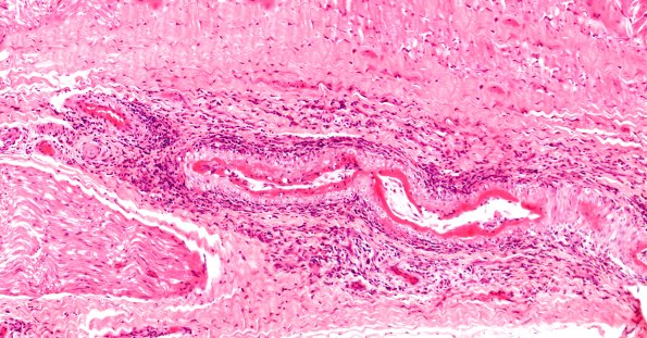 15A1 PAN (Case 15) H&E 10X