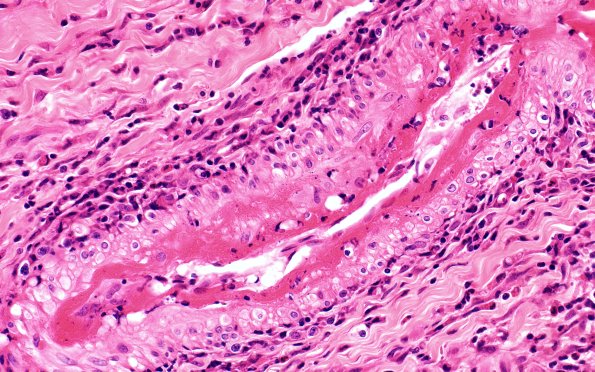 15A2 PAN (Case 15) H&E 40X