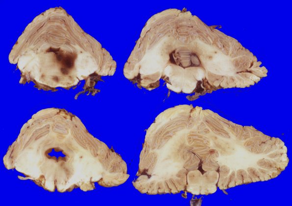 16 Polyarteritis nodosa (Case 16)